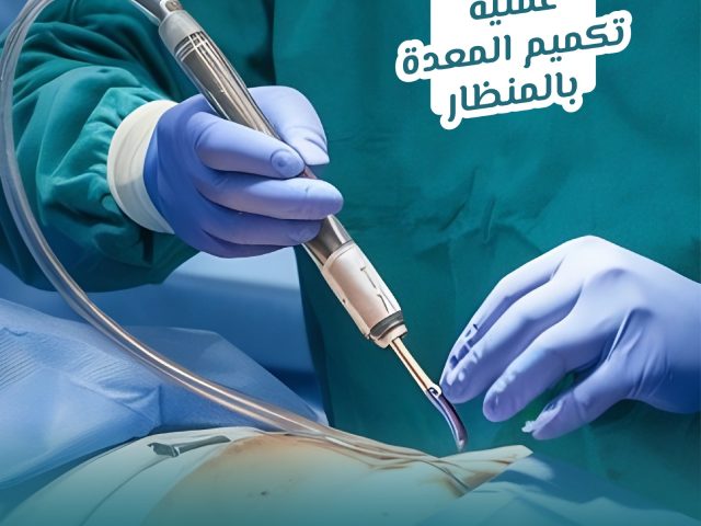 عملية تكميم المعدة بالمنظار