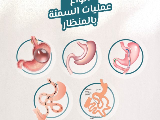 انواع عمليات السمنة بالمنظار