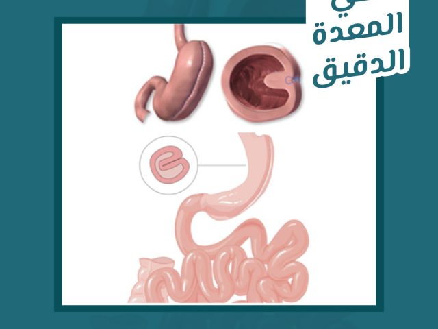 طي المعدة الدقيق