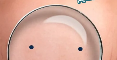 فتحات عملية التكميم