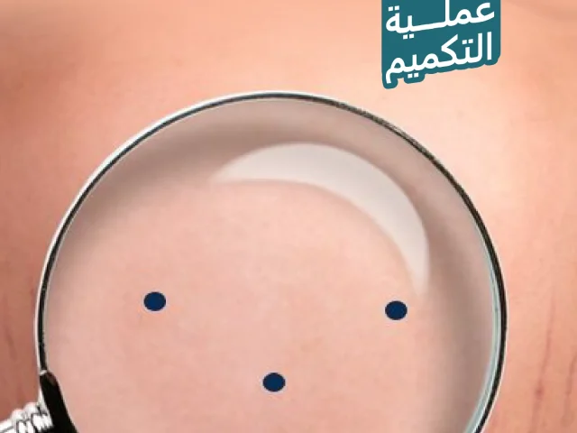 فتحات عملية التكميم